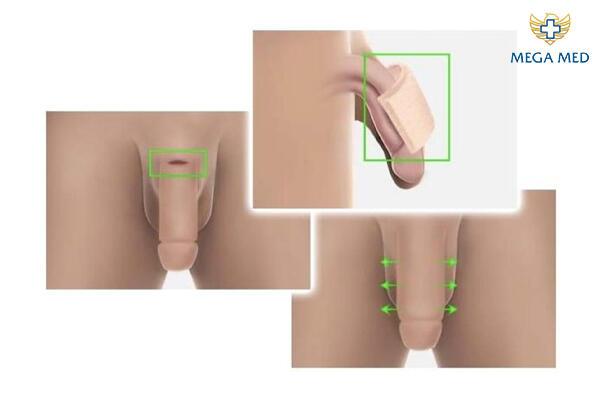 Làm to dương vật tự nhiên, an toàn